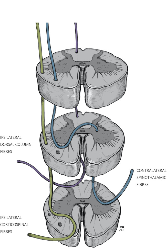 MRI of spinal cord hemisection showing Brown-Sequard syndrome