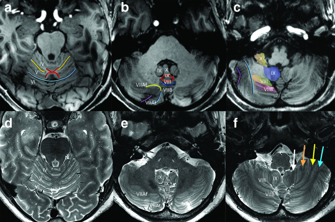 MRI atlas showing functional divisions of the cerebellum including vestibulocerebellum, spinocerebellum, and cerebrocerebellum