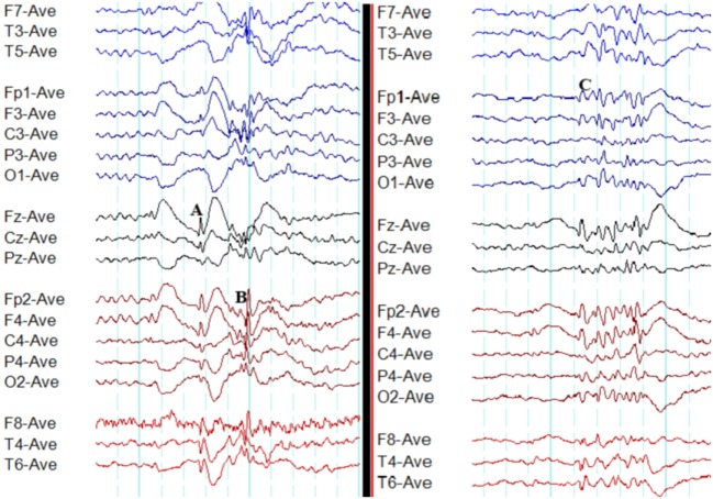 EEG recording showing generalized 3 Hz spike-and-wave discharges in childhood absence epilepsy
