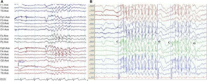 EEG showing polyspike-and-wave discharges characteristic of juvenile myoclonic epilepsy