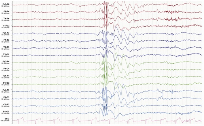 EEG recording showing slow spike-and-wave pattern characteristic of Lennox-Gastaut syndrome