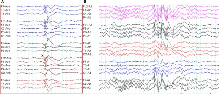 EEG recordings showing various epileptiform patterns including spike-and-wave and polyspike discharges