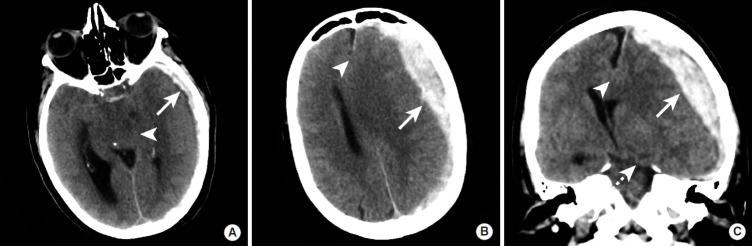 MRI appearance of intracranial hemorrhage at different stages showing signal changes over time