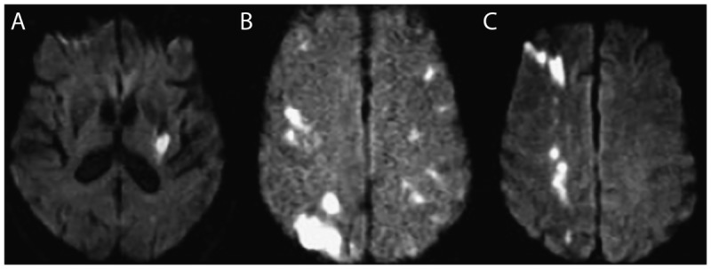 CT scan showing different types of intracerebral hemorrhage with surrounding edema and mass effect