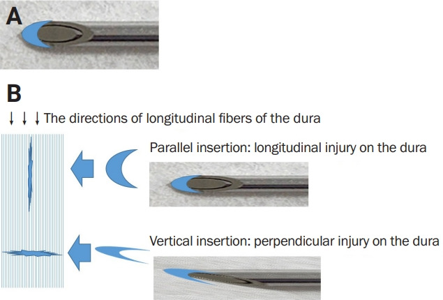 Diagram comparing atraumatic and cutting spinal needle tips used for lumbar puncture
