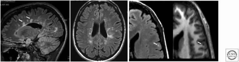 Brain MRI showing periventricular white matter lesions in multiple sclerosis with Dawson fingers pattern