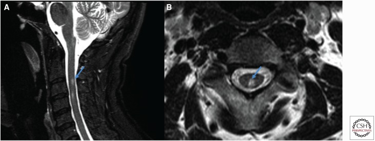 MRI of the spinal cord showing demyelinating lesions in multiple sclerosis