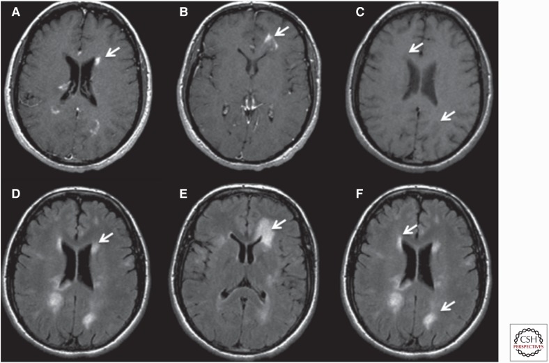 T1-weighted MRI showing black holes representing chronic axonal loss in multiple sclerosis