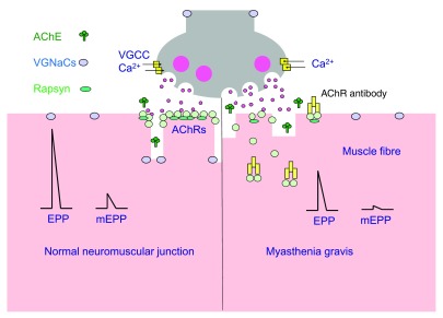 Diagram of the neuromuscular junction in normal state and in myasthenia gravis showing antibody-mediated AChR loss