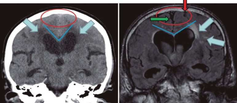 MRI demonstrating imaging signs of idiopathic intracranial hypertension and normal pressure hydrocephalus