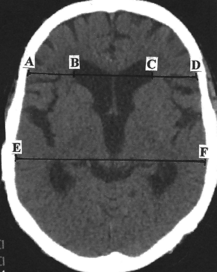 MRI showing ventriculomegaly out of proportion to sulcal enlargement in normal pressure hydrocephalus