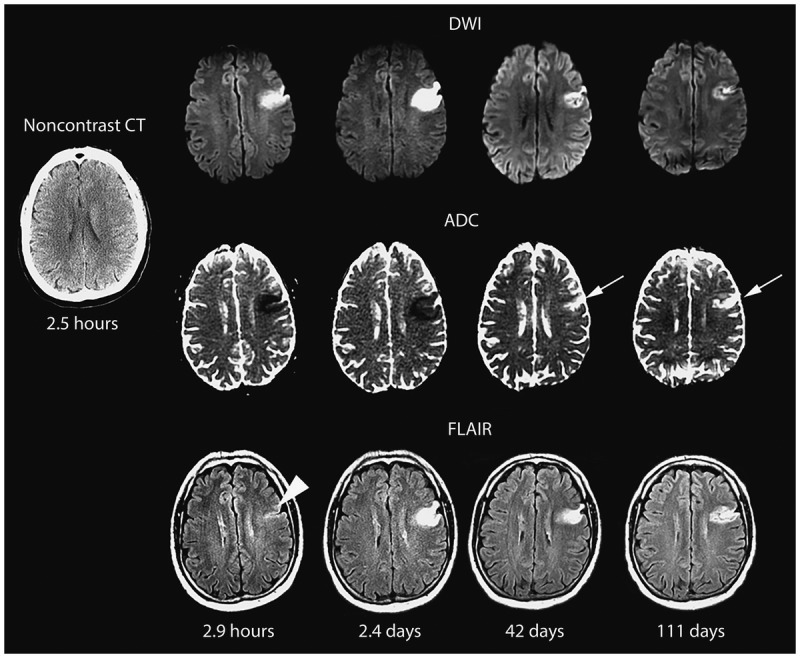 CT and angiographic imaging of subarachnoid hemorrhage showing blood distribution and aneurysm