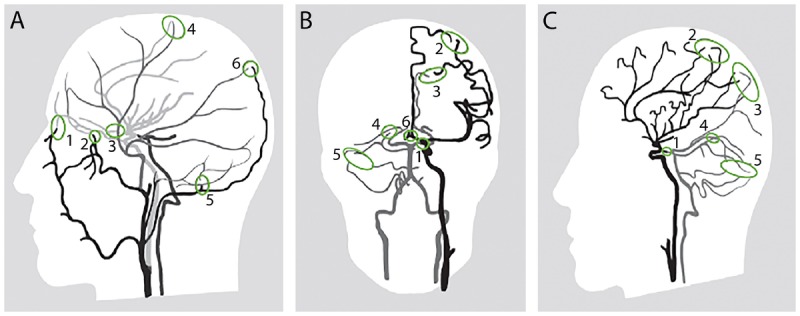 CT angiography showing large vessel occlusion in acute ischemic stroke