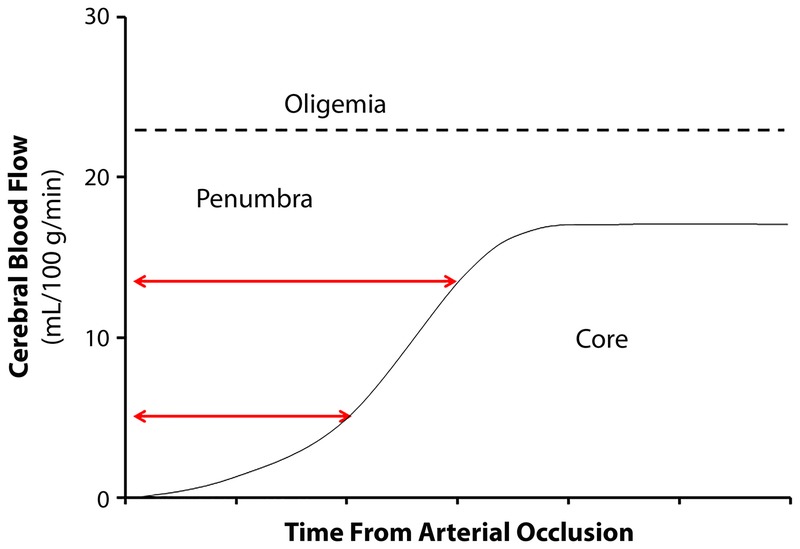 CT perfusion map showing ischemic core and penumbra mismatch in acute stroke
