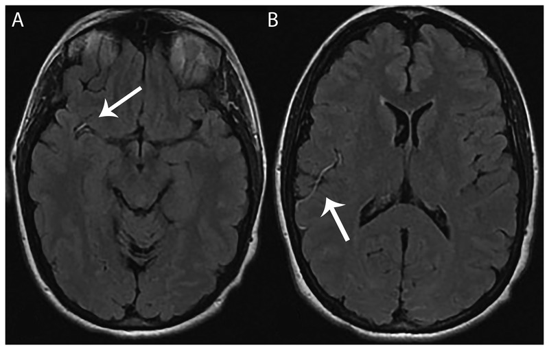 Illustration of axonal versus demyelinating peripheral nerve pathology patterns on nerve conduction studies