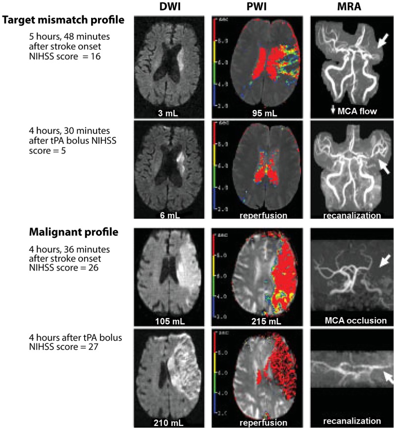 Imaging showing mechanical thrombectomy procedure for large vessel occlusion stroke