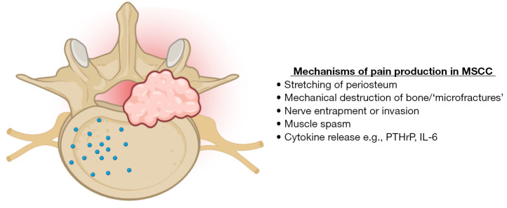 Diagram showing mechanisms of pain production in malignant spinal cord compression