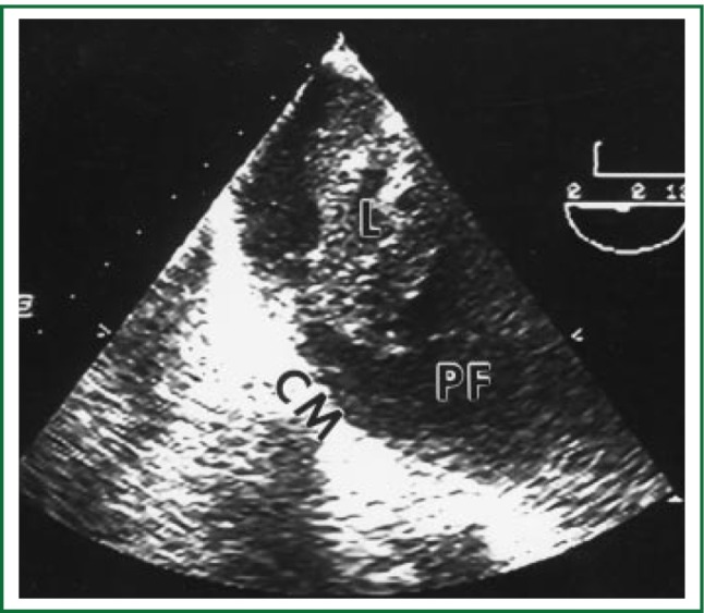Algorithm for management of malignant pleural effusion showing decision pathway from thoracentesis to pleurodesis or indwelling catheter