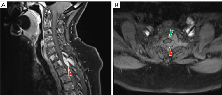 MRI showing malignant spinal cord compression at T1 level in sagittal and axial planes