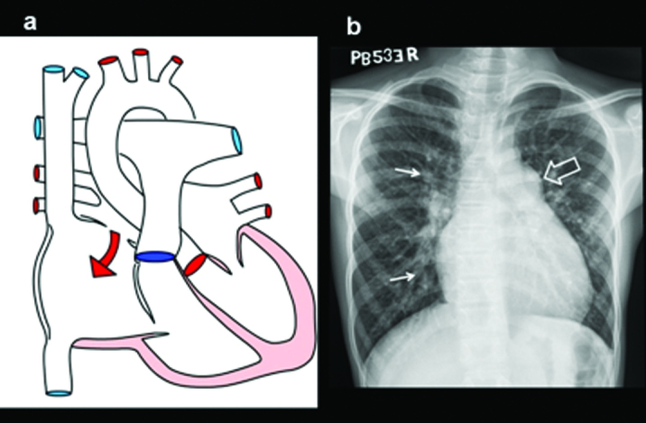 Atrial septal defect diagram with chest radiograph and echocardiographic imaging