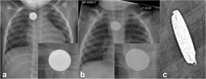 Frontal chest radiographs comparing a coin versus a button battery in the esophagus, showing the double-rim halo sign