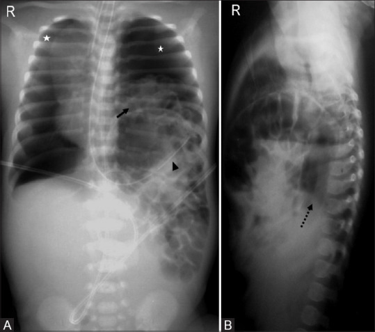 Chest radiograph of congenital diaphragmatic hernia showing cystic lucencies in the left hemithorax representing bowel loops