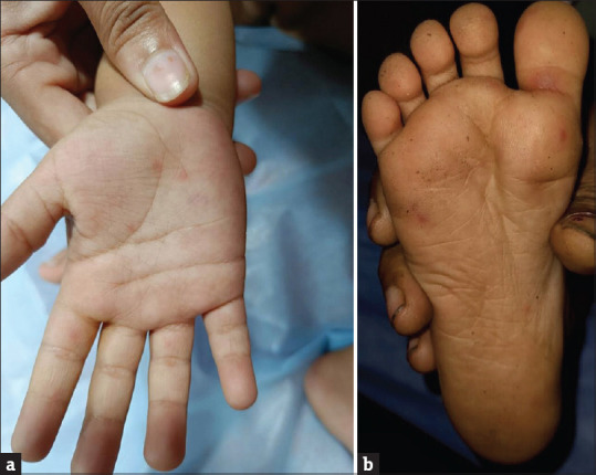 Discrete erythematous macules on the palms and soles in hand-foot-and-mouth disease