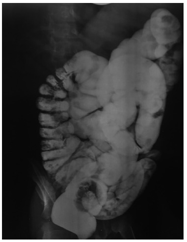 Barium enema in Hirschsprung disease showing delayed passage of contrast material and abnormal bowel caliber