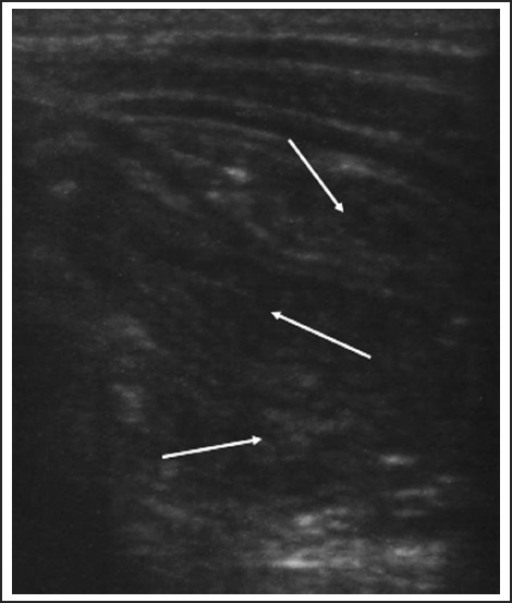 Longitudinal ultrasound showing the hayfork sign representing the apex of intussusception