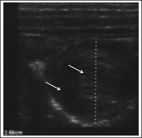 Transverse ultrasound showing the target or bull's eye sign of intussusception with hypoechoic ring surrounding echogenic center