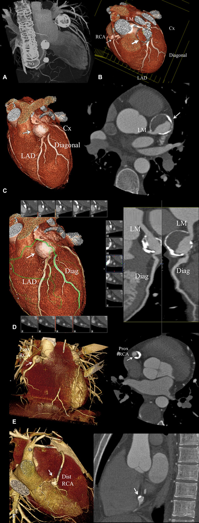 Coronary CT angiography showing calcified coronary artery aneurysms with mural thrombus in Kawasaki disease
