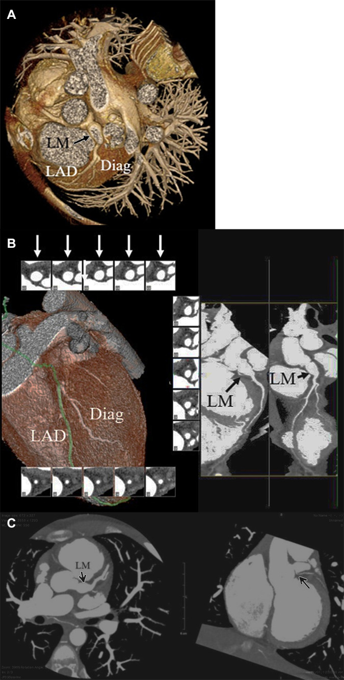 CT angiography showing residual fusiform coronary artery aneurysm after Kawasaki disease treatment