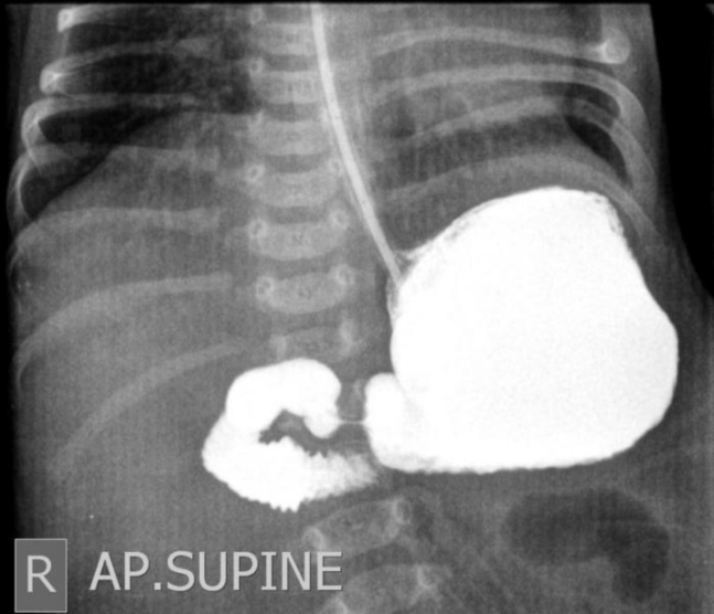 Upper GI series showing malrotation with abnormal position of duodenojejunal junction and absence of distal contrast passage