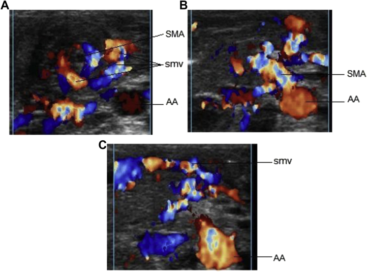 Color Doppler ultrasound showing the whirlpool sign with superior mesenteric vessels wrapped around twisted mesentery in midgut volvulus