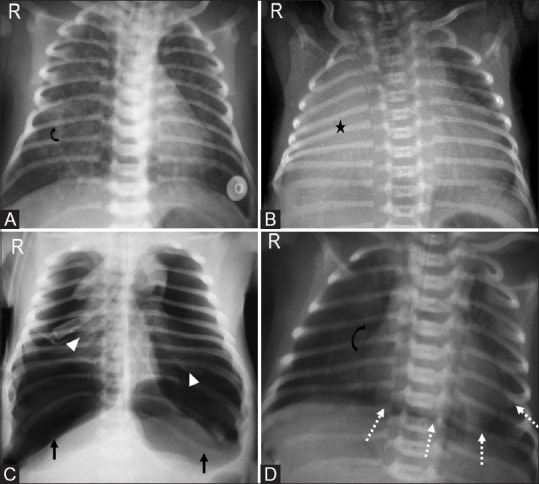 Chest radiograph of meconium aspiration syndrome showing hyperinflated lungs with coarse bilateral infiltrates