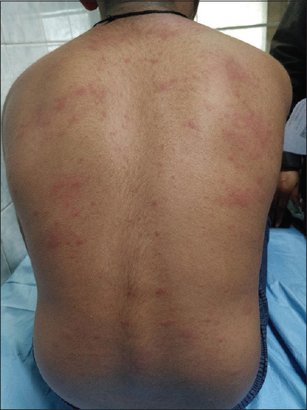 Maculopapular rash present over the back in a case of measles infection