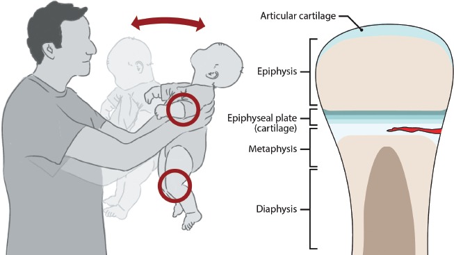 Diagram showing the proposed mechanism of metaphyseal injury from shaking with illustration of fracture site at the growth plate