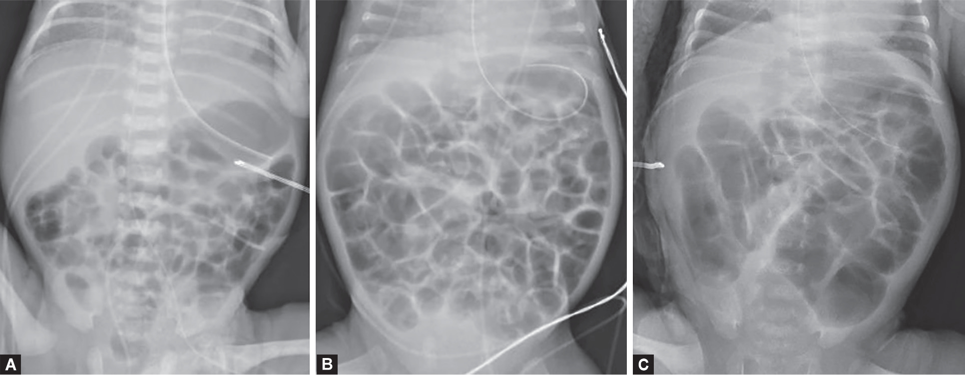 Normal versus abnormal bowel gas patterns on neonatal abdominal radiograph