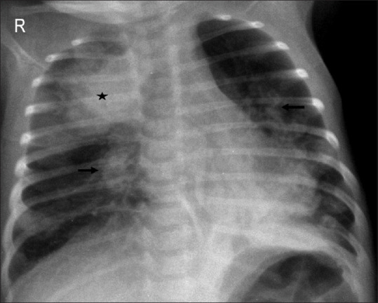 Neonatal chest radiograph showing consolidation and perihilar opacities consistent with neonatal sepsis/pneumonia
