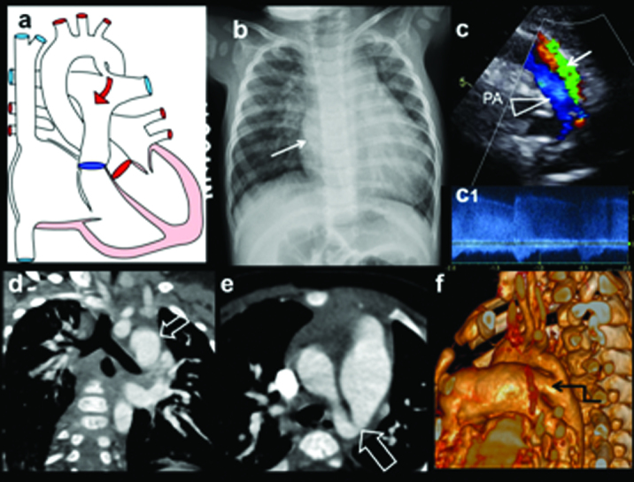 Patent ductus arteriosus diagram with Doppler imaging and 3D reconstruction