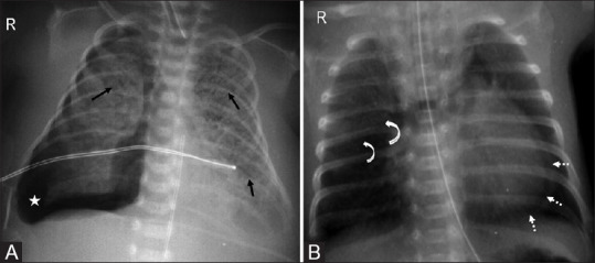 Neonatal chest radiograph showing pneumothorax with mediastinal shift and pneumomediastinum