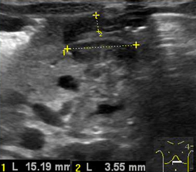 Ultrasound image showing abnormal elongation of the pyloric canal in pyloric stenosis