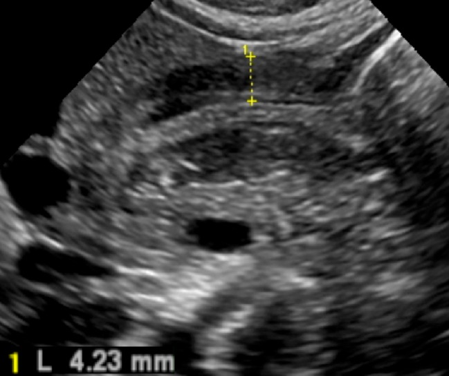 Ultrasound image showing hypertrophied pyloric muscular layer in pyloric stenosis