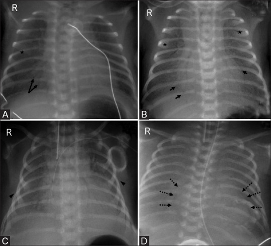 Chest radiograph progression of respiratory distress syndrome showing fine granularity with air bronchograms to complete whiteout lung