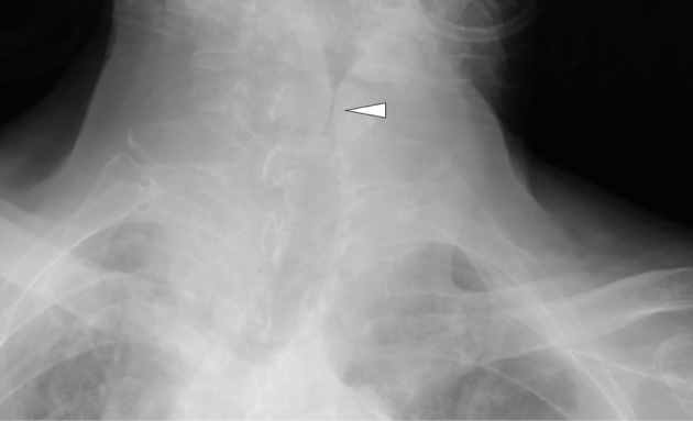 Anteroposterior neck radiograph showing the steeple sign of subglottic narrowing in croup
