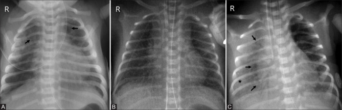 Neonatal chest radiograph showing changes after surfactant administration in respiratory distress syndrome