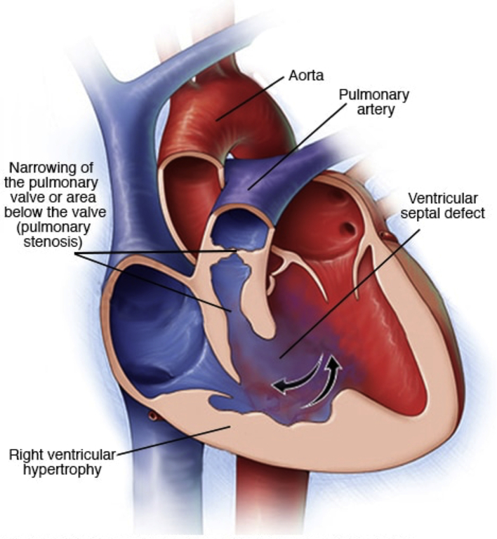 Diagram showing the four anatomical features of Tetralogy of Fallot: VSD, overriding aorta, RVOT obstruction, and right ventricular hypertrophy