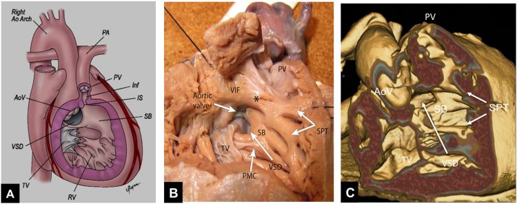 Echocardiographic and surgical images of Tetralogy of Fallot showing the obstructive components and conal septum displacement