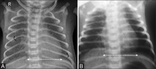 Chest radiograph of transient tachypnea of the newborn showing coarse interstitial markings and mild cardiomegaly