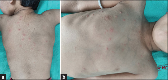 Vesicular rash over the trunk and back with lesions in different stages, clinically diagnosed as varicella zoster infection